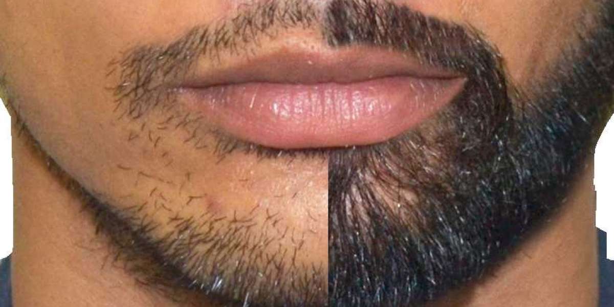 Implante De Barba Precio