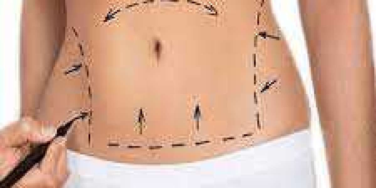 Best Treatment Of Mini Tummy Tuck In Dubai - Cornerstone Clinic