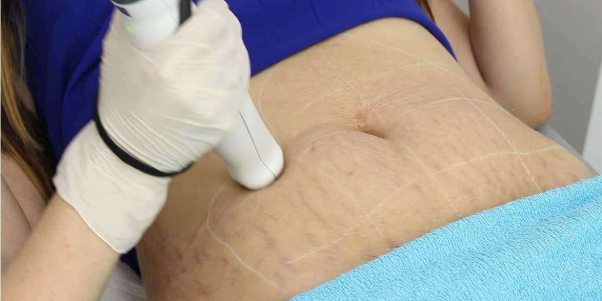 Stretch Marks Treatment Market Size, Share, Growth & Report 2023-2028