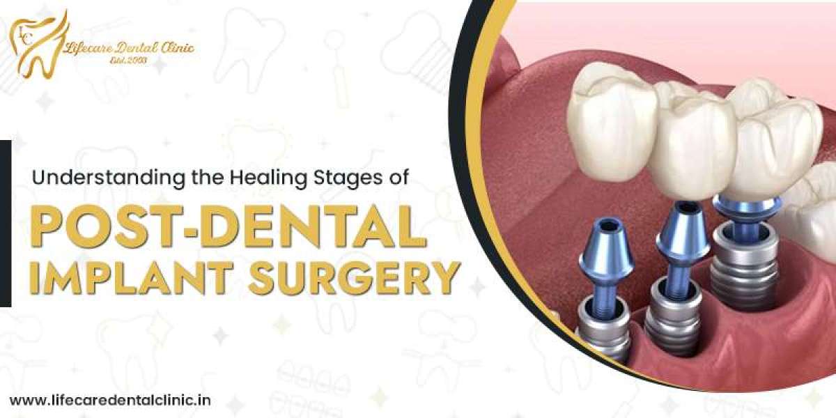 Understanding the Healing Stages of Post-Dental Implant Surgery