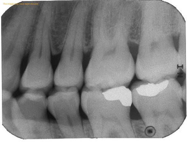 A Comprehensive Guide to Aftercare for Dental Implants: kamperiodntist — LiveJournal