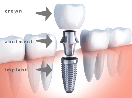 Dental Implant Cost in Gurgaon | Aspen Dental