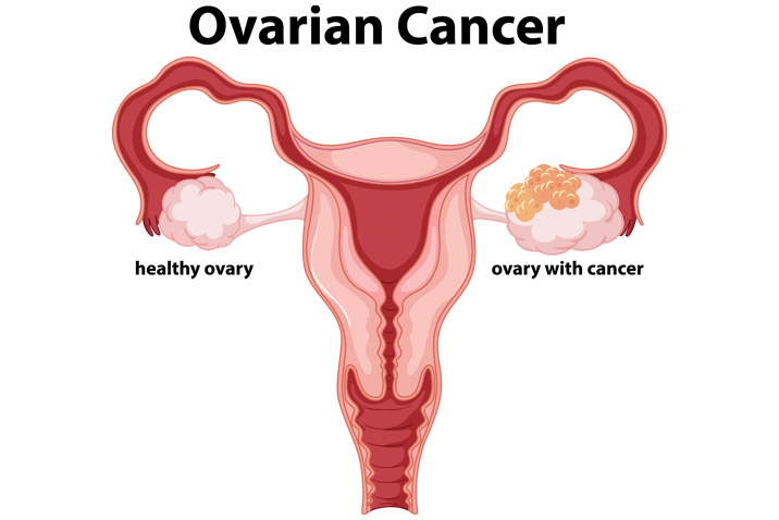 Is Cervical Cancer dangerous? - Role of oncologist kolkata