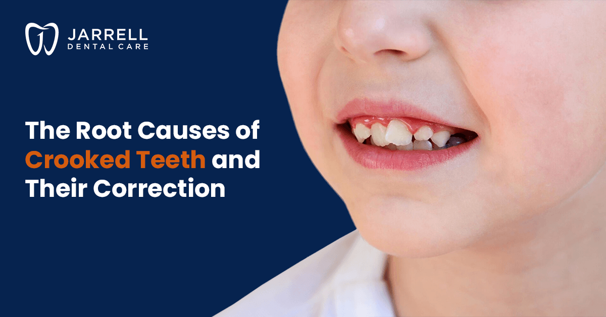 Root Causes of Crooked Teeth & Their Correction