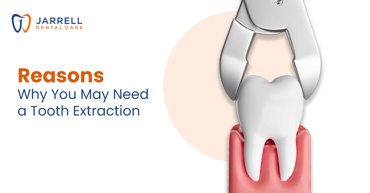 5 Reasons Why You May Need a Tooth Extraction