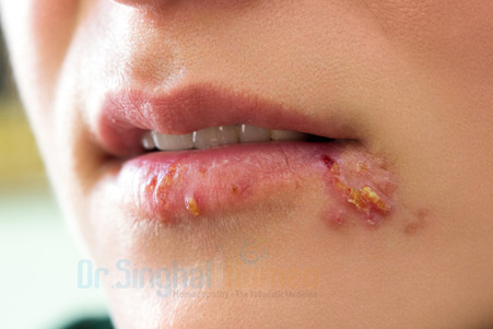 Homeopathic Treatment for Herpes With the Best Results